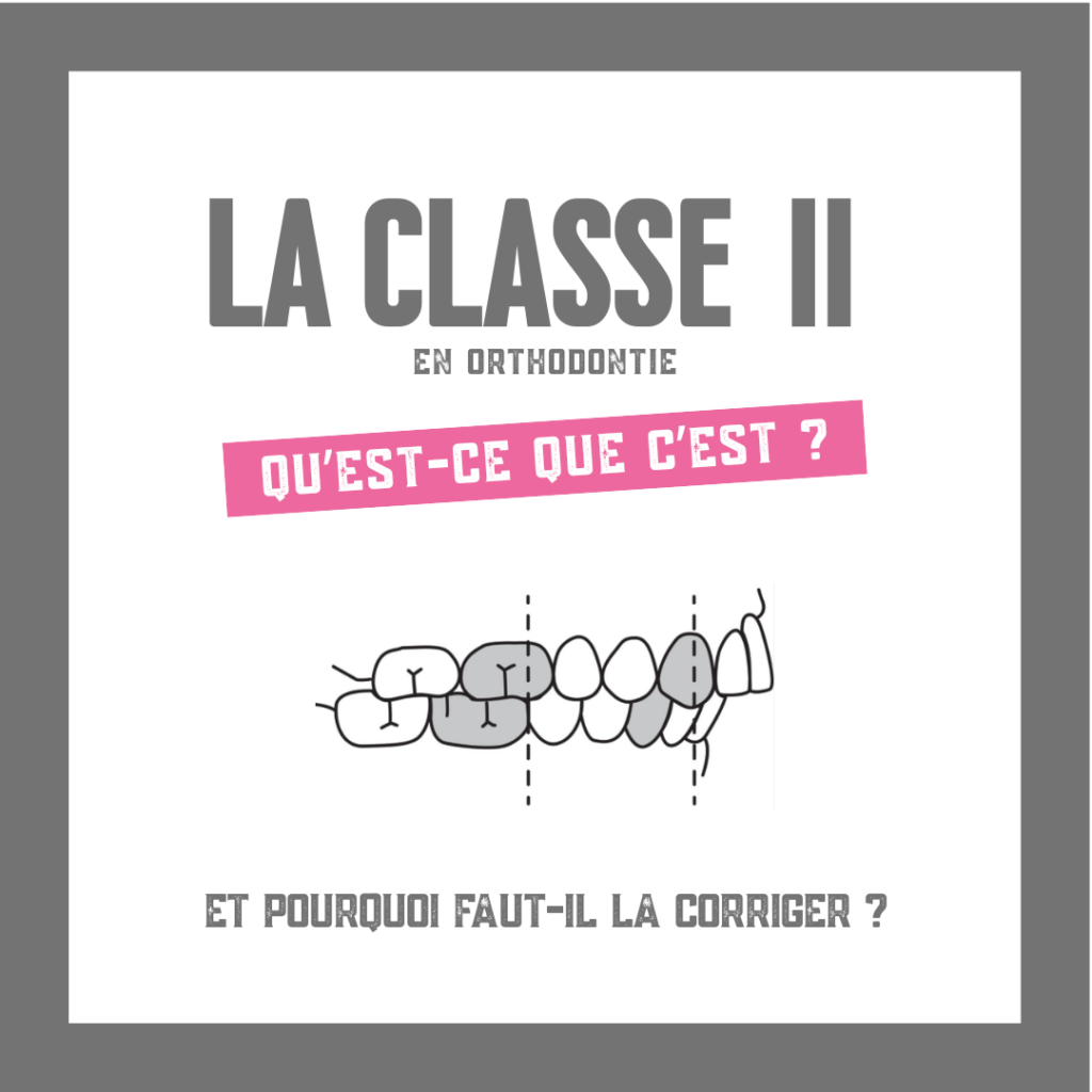 La classe II EN ORTHODONTIE