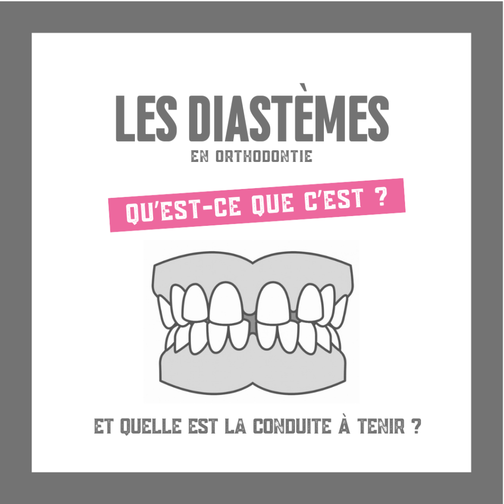 Les diastèmes en orthodontie ✅